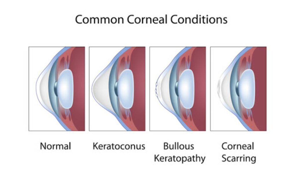 common corneal conditions