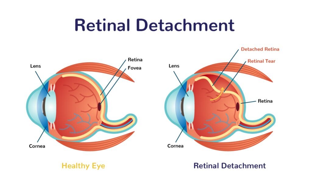 retinal detachment