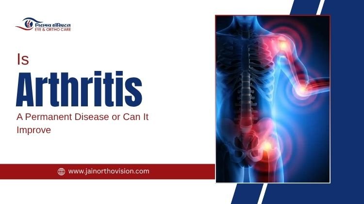 Is Arthritis a Permanent Disease or Can It Improve?