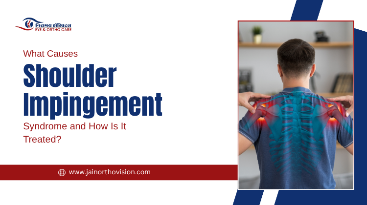 What Causes Shoulder Impingement Syndrome and How Is It Treated?